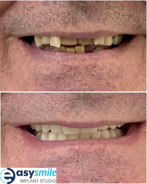 full-mouth implant in kent|Dental implant specialist in Kent, EasySmile modern dental surgery.